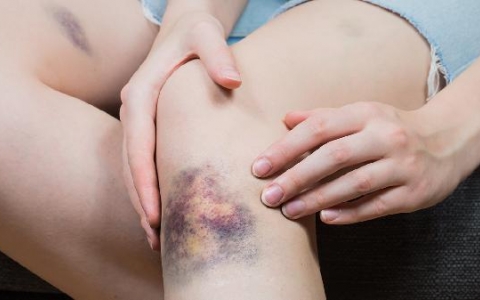 脸上有打的淤青怎么办