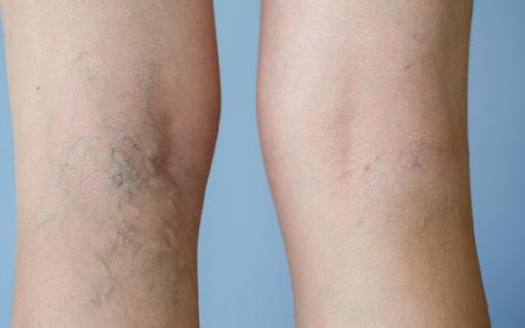 弥漫性水肿是什么原因