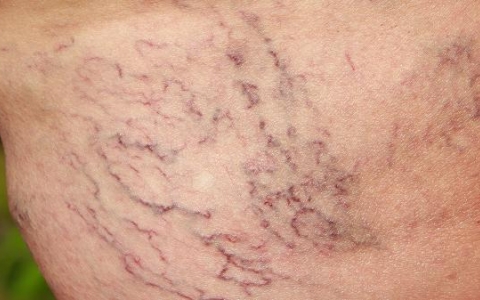 早上冰敷可以去水肿吗