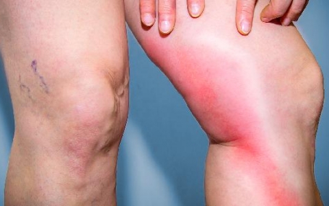 全身一直水肿什么原因