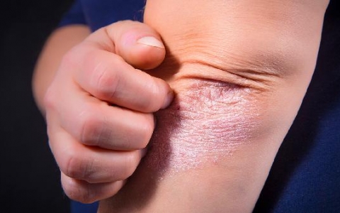 全身皮肤瘙痒是什么原因造成的怎么治疗