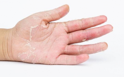 脚后跟一直脱皮怎么办