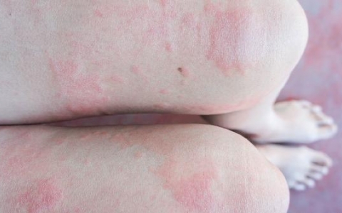 疱疹为什么总是反复起