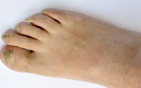 手足口接触后怎么补救