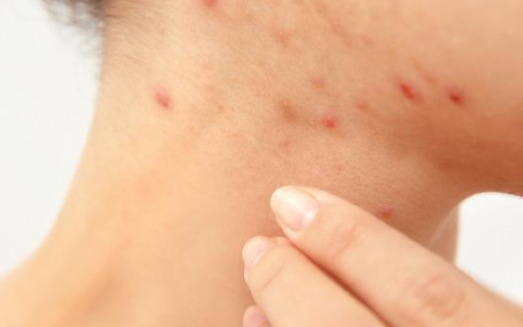 咽部疱疹吃什么药好得快