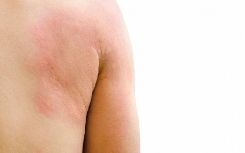 手上汗疱疹是什么样的