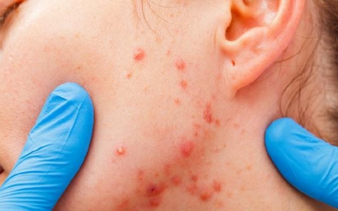 过敏自己会慢慢恢复吗