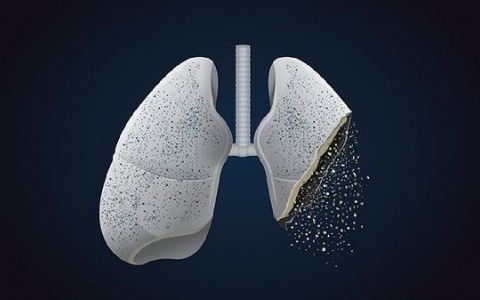 肺结节怎么治疗吃什么药