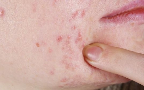 十岁男孩过敏吃什么药