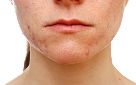 过敏了没有药怎么止痒