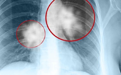 肺淋巴结肿大吃什么药好得快