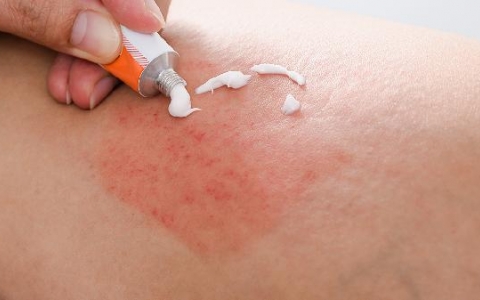 咽部疱疹吃什么药好