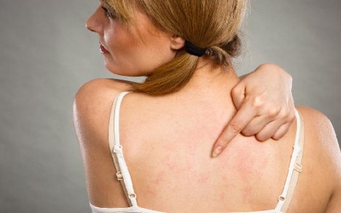 孕妇得汗疱疹怎么治疗好呢