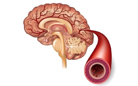 沙棘对脑血管病有好处吗