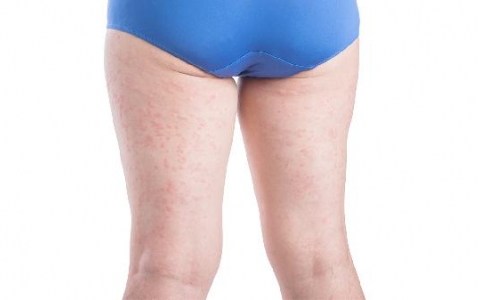 大腿痒可以涂什么药膏