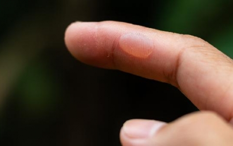 肺起水泡怎么治疗