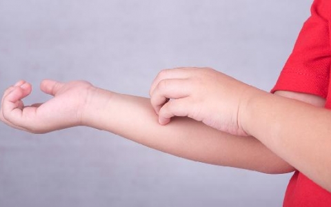 儿童急性疱疹会传染吗