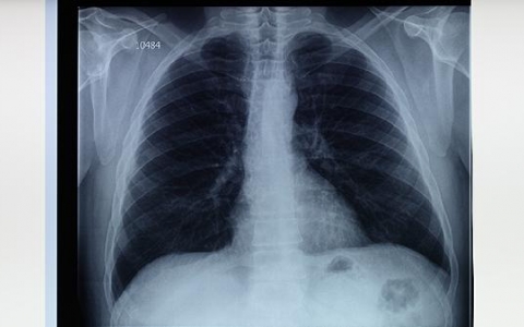 良性肺结核会传染吗一起吃饭