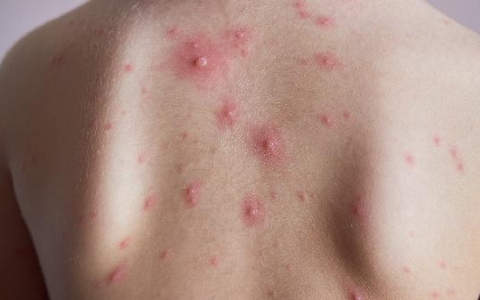 水痘的症状和治疗的方法?