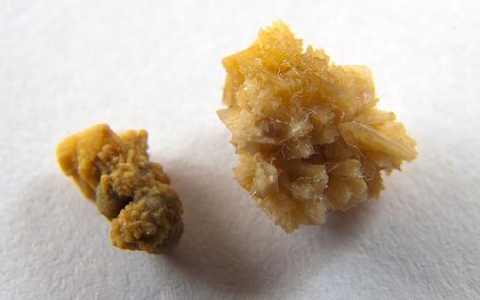 泌尿系统结石有什么快速排石方法