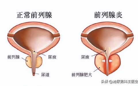 老公前列腺炎能备孕吗